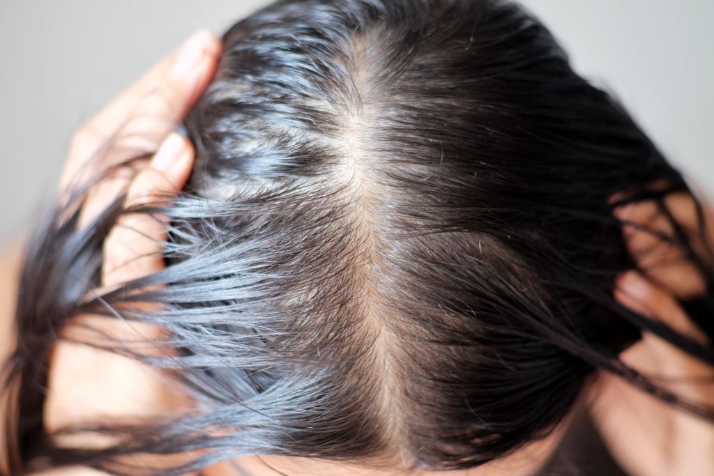 Alopecia areata, thinning hair, higher hairline