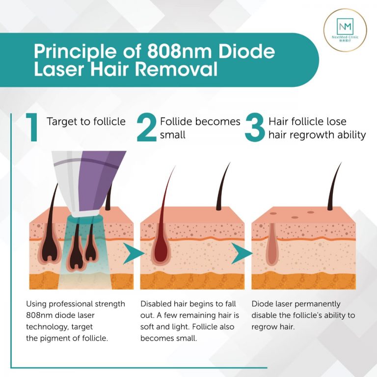 principle of laser hair removal
