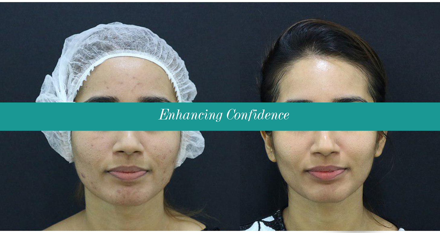 acne scar treatment clinic in malaysia