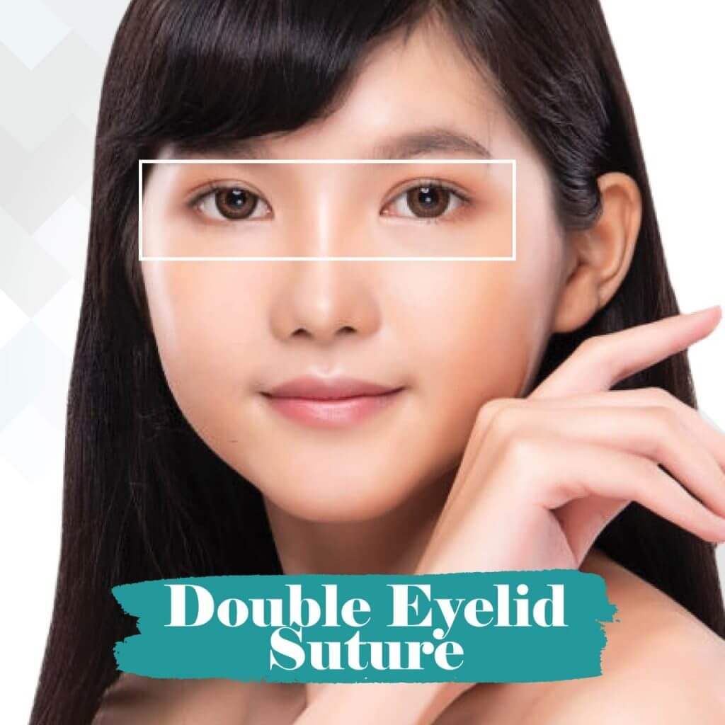 Double-eyelid-suture-malaysia