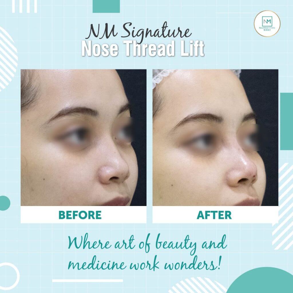 nose-thread-lift-in-kl