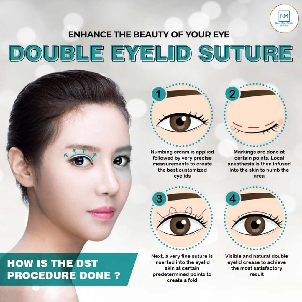 double eyelid suture malaysia