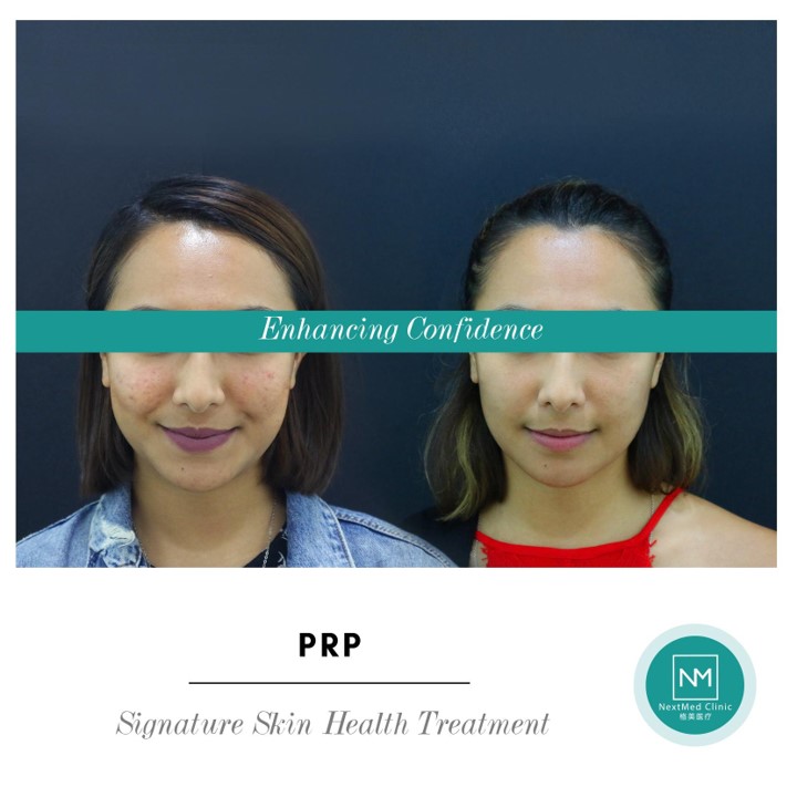 acne-scar-treatment-malaysia