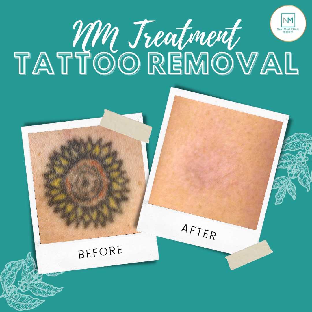 tattoo- removal -before- and- after