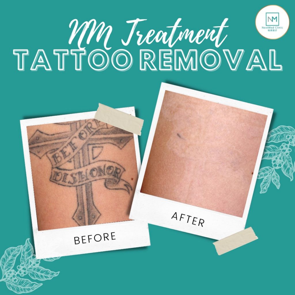 tattoo-removal-petaling jaya-