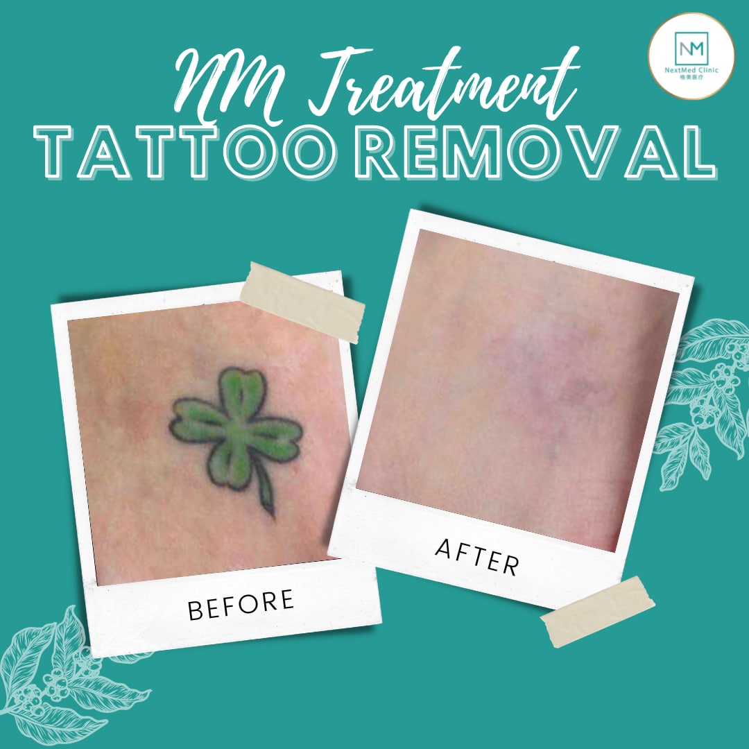 tattoo-removal-nextmed-clinic-