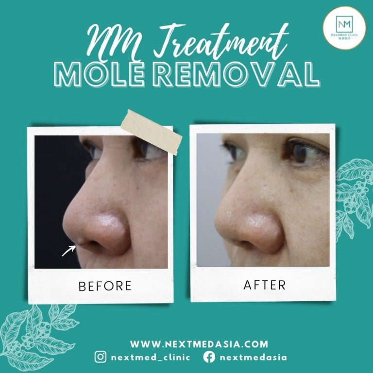 mole-removal-malaysia