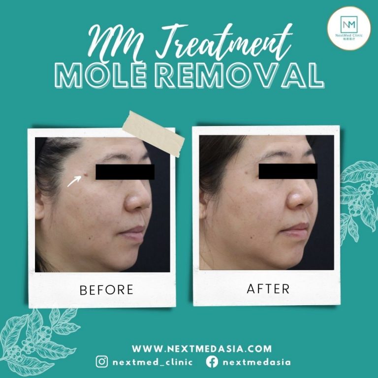 laser-mole-removal
