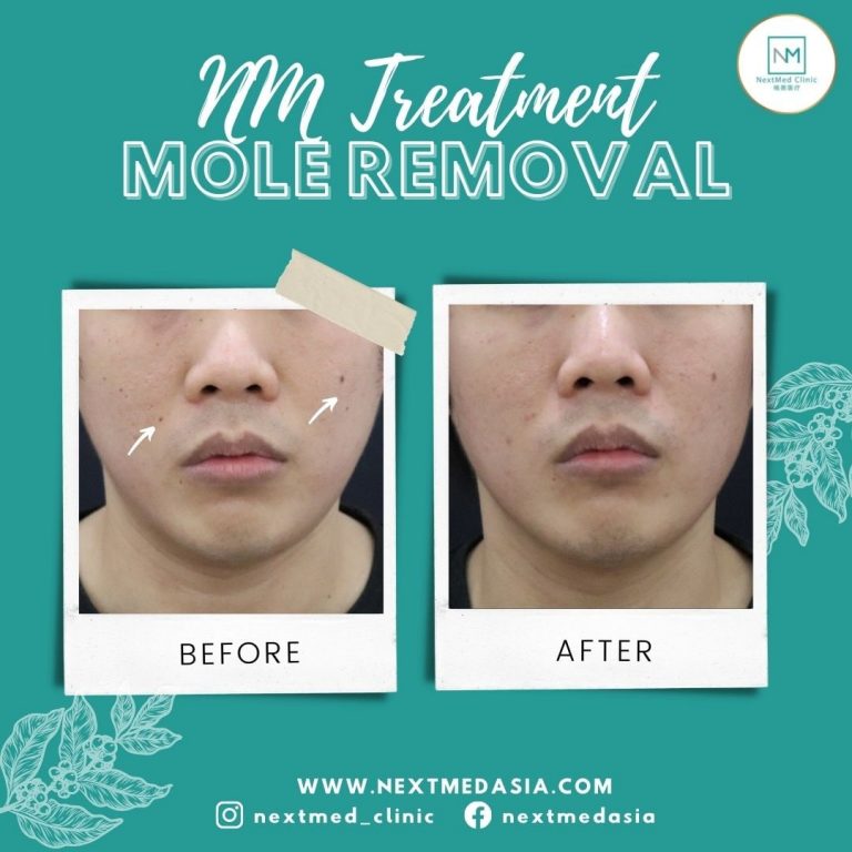 mole-removal
