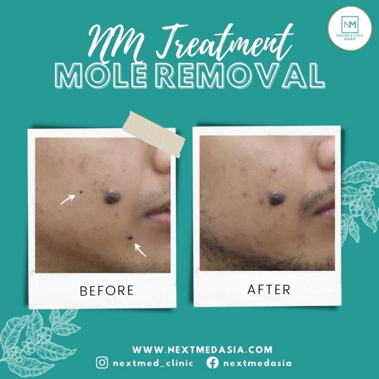 laser-mole removal