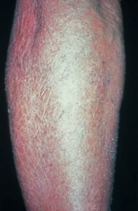 asteatotic-eczema-eczema