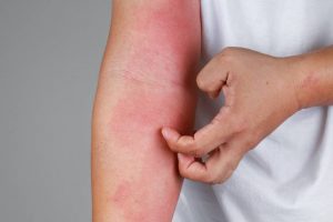 atopic-eczema-atopic-dermatitis