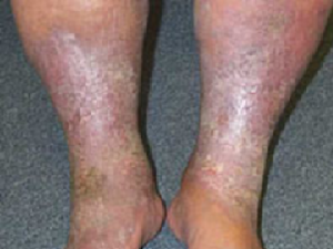 statis-dermatitis-eczema