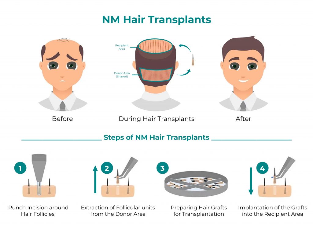 hair transplant clinic in malaysia