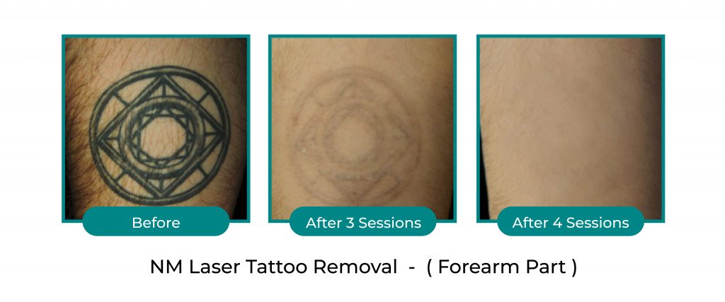laser-tattoo-removal-kuala-lumpur