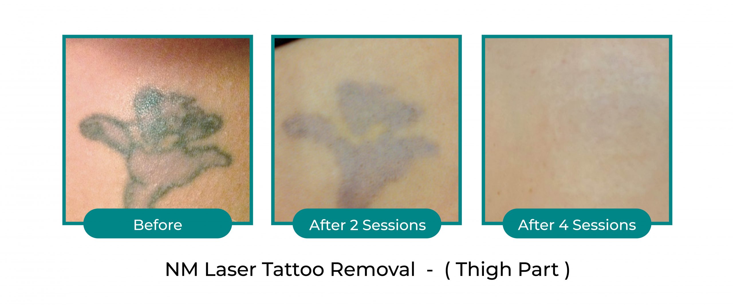 NextMed Laser tattoo before after official (3)