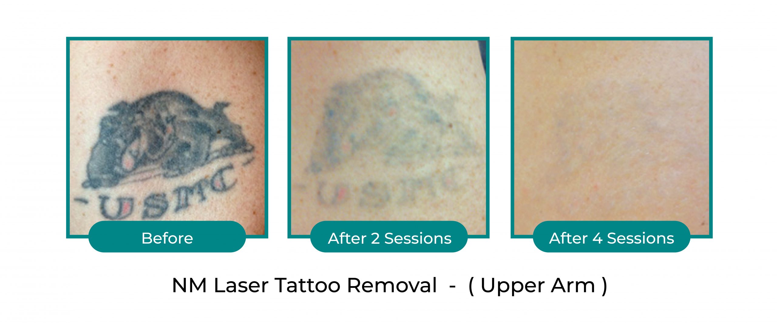NextMed Laser tattoo before after official (4)