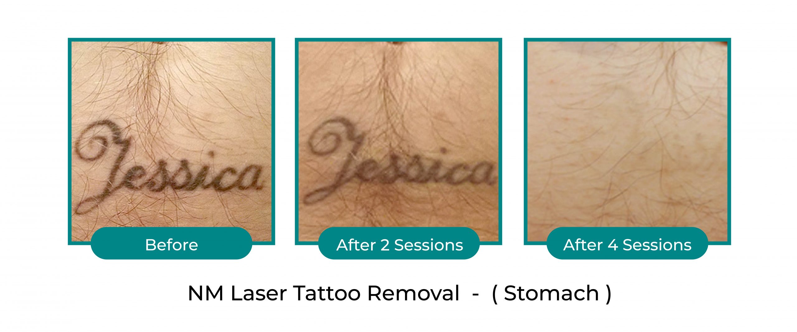 laser tattoo blog-09
