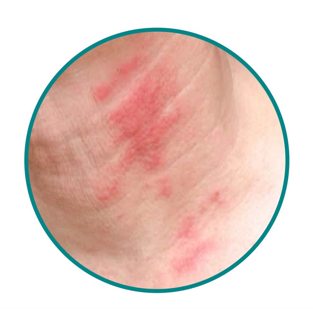 post-inflammatory pigmentation-acne-dermatitis-eczema