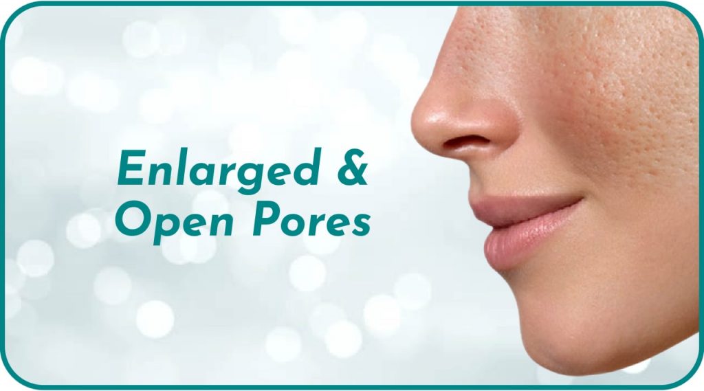 enlarged open pores